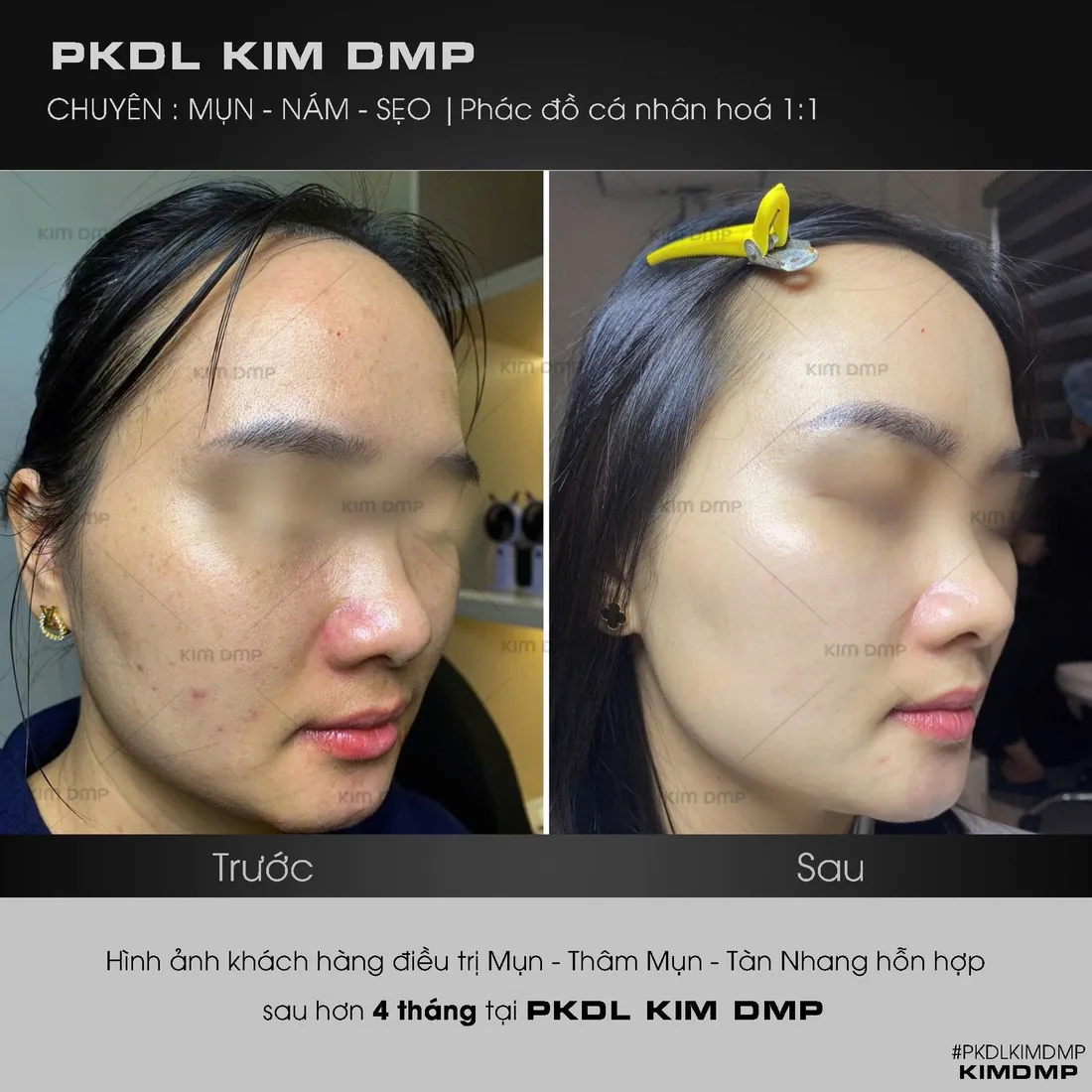 Hình ảnh trước và sau khi chăm sóc mụn, thâm mụn và tàn nhang hỗn hợp tại Kim DMP Gò Vấp