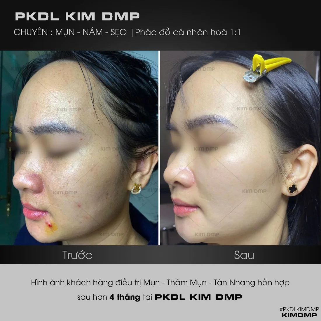 Hình ảnh trước và sau khi chăm sóc mụn, thâm mụn và tàn nhang hỗn hợp tại phòng khám da liễu Kim DMP Gò Vấp
