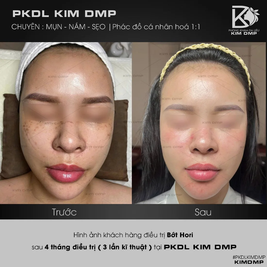 Hình ảnh trước và sau khi chăm sóc bớt hori tại phòng khám da liễu Kim DMP Gò Vấp