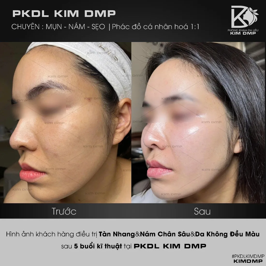 Hình ảnh trước và sau khi chăm sóc tàn nhang, nám chân sâu và da không đều màu tại Kim DMP Gò Vấp