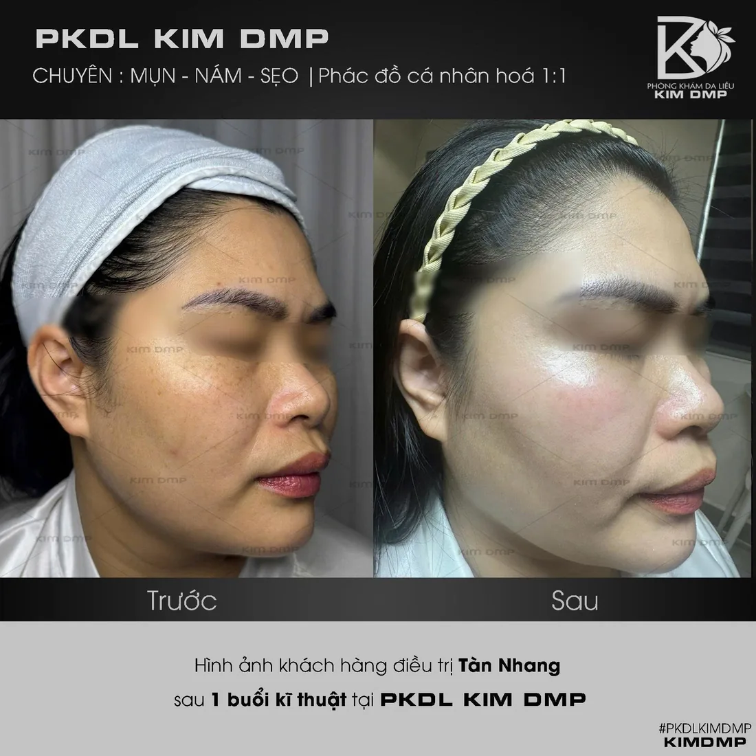 Hình ảnh trước và sau khi chăm sóc tàn nhang tại Kim DMP Gò Vấp