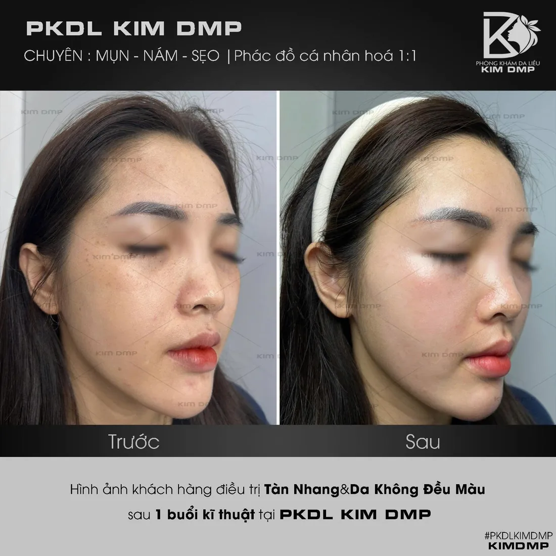 Hình ảnh trước và sau khi chăm sóc tàn nhang và da không đều màu tại Kim DMP Gò Vấp