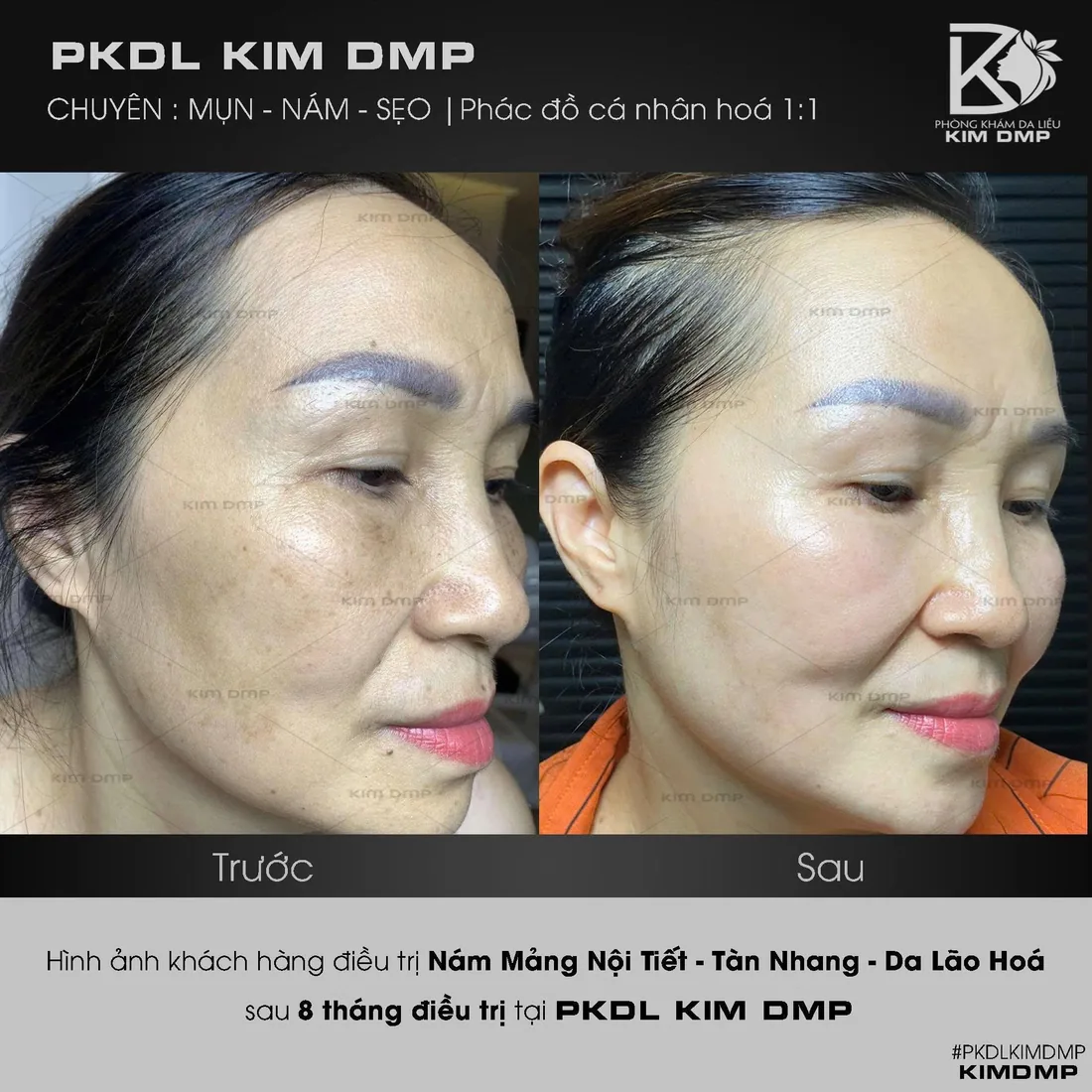 Hình ảnh trước và sau khi chăm sóc nám mảng nội tiết, tàn nhang và da lão hóa tại phòng khám da liễu Kim DMP Gò Vấp