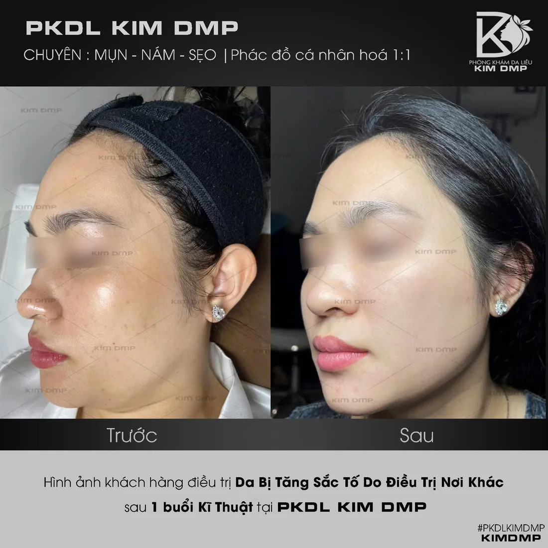 Hình ảnh trước và sau khi chăm sóc da bị tăng sắc tố sau khi làm ở nơi khác tại phòng khám da liễu Kim DMP Gò Vấp