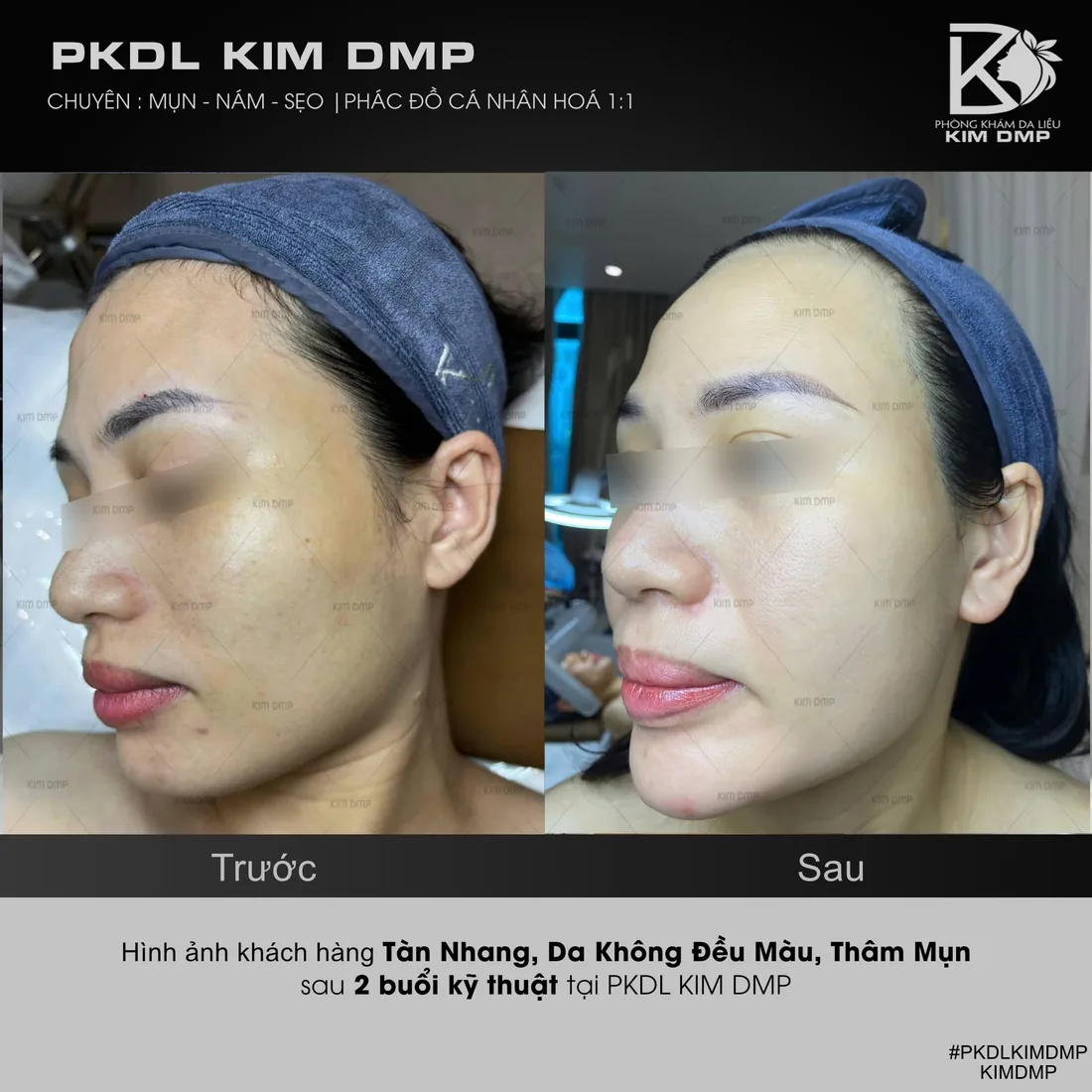 Hình ảnh trước và sau khi chăm sóc tàn nhang, da không đều màu và thâm mụn tại phòng khám da liễu Kim DMP Gò Vấp