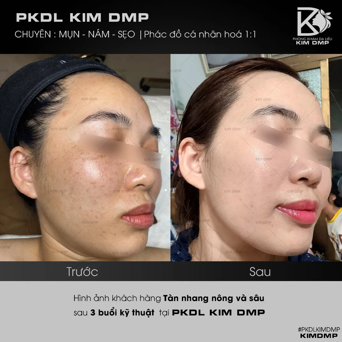 Hình ảnh trước và sau khi chăm sóc tàn nhang nông và sâu tại phòng khám da liễu Kim DMP Gò Vấp